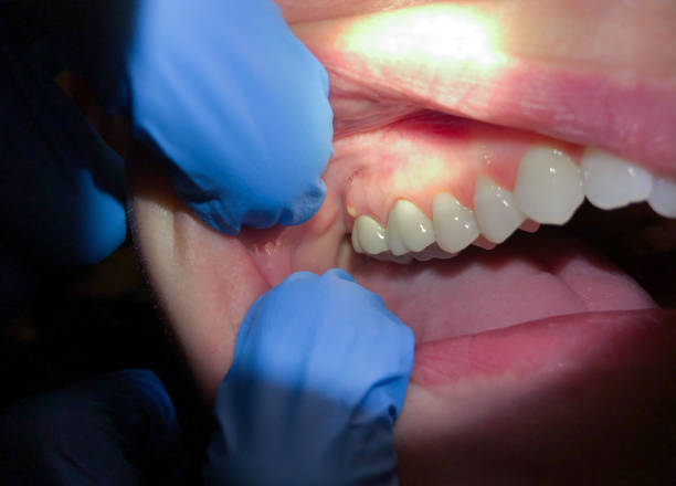 Best Emergency Broken Tooth Repair in Clayton, MO