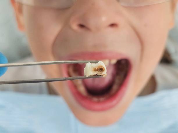 Best Emergency Treatment for Toothache in Clayton, MO